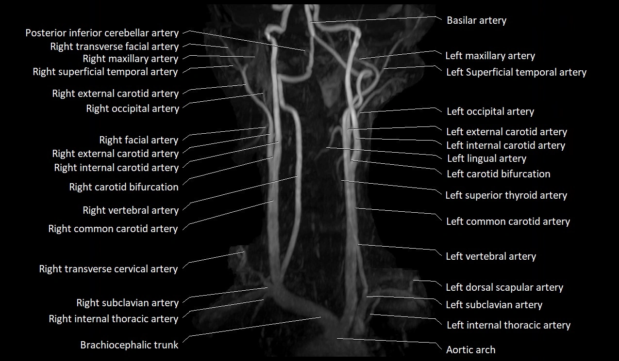MRA neck carotid arteries labeled anatomy image MIP 3D image 4.webp